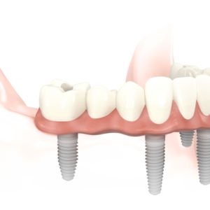 hibrida sobre implantes inferior