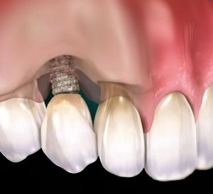 periimplantitis