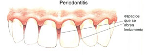 periodontitis